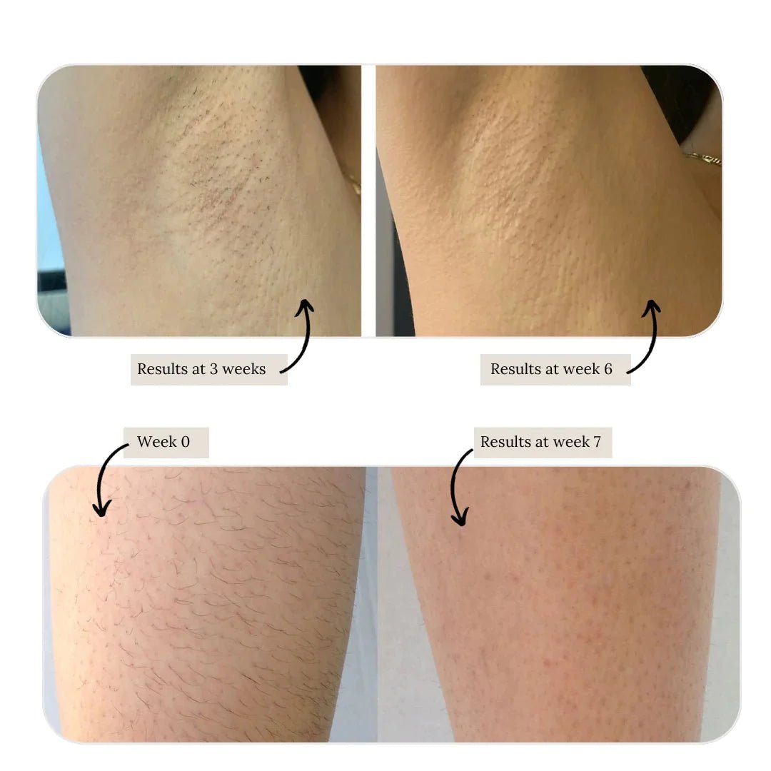 KENZZI IPL Hair Removal Handset + FREE Microderm - Kenzzi