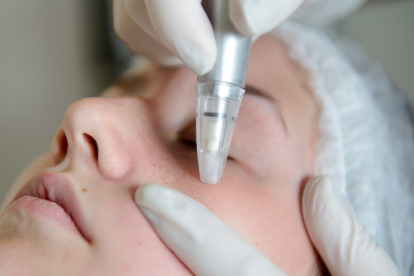 At-Home Microdermabrasion Options - Kenzzi