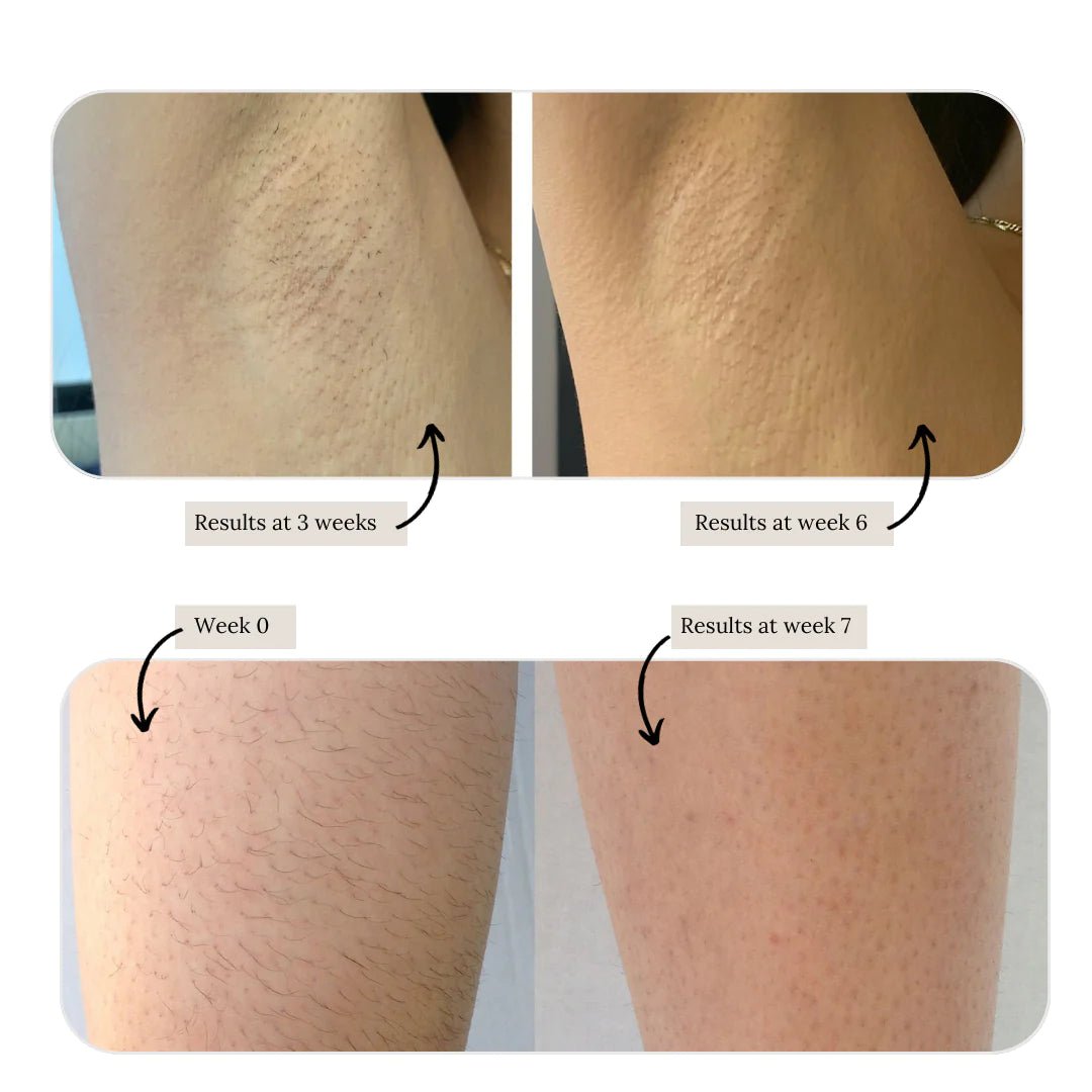 Kenzi online hair removal